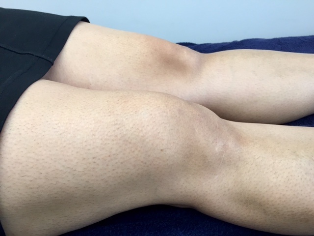 The most common cause for a swollen knee in a young woman